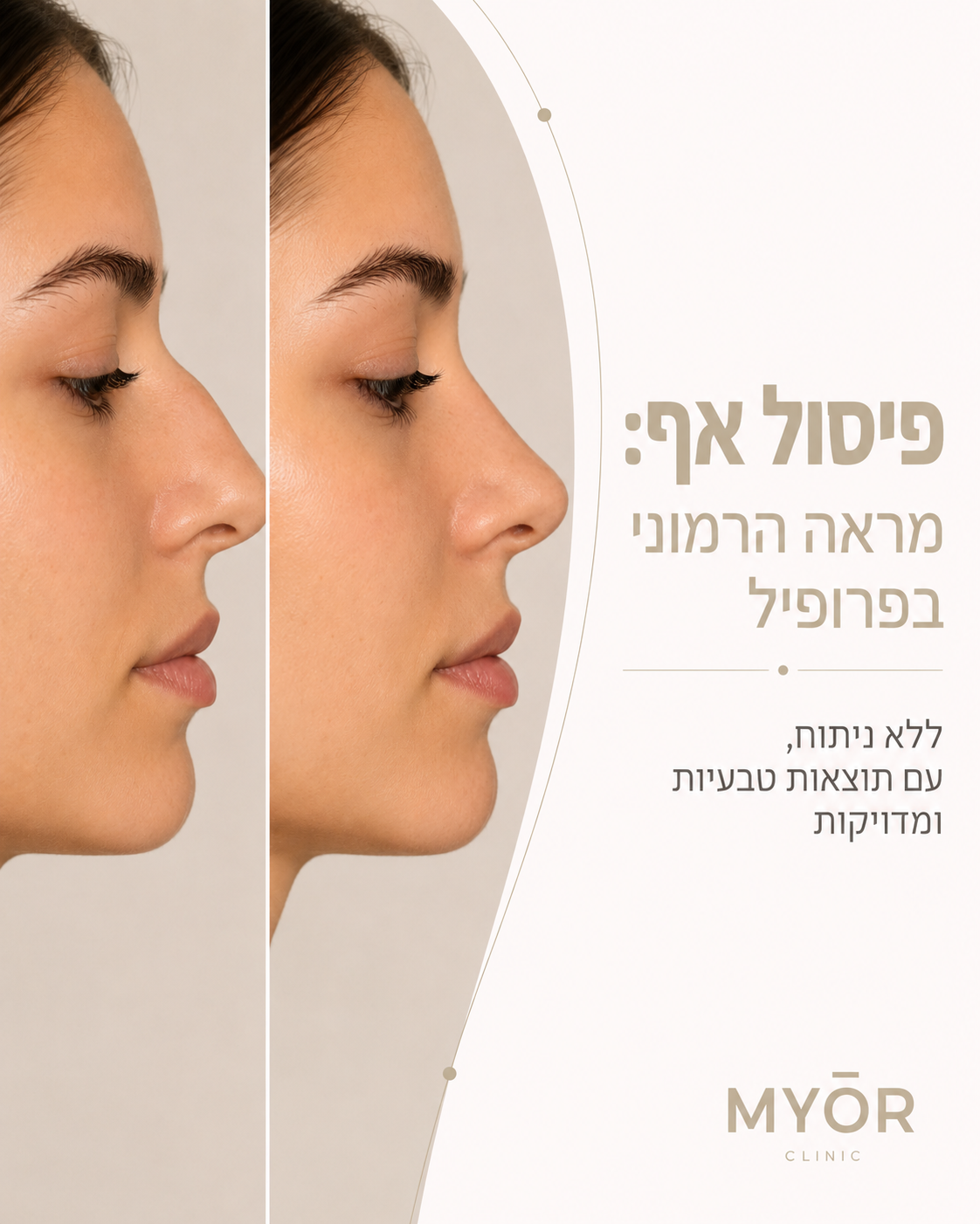 הכירו את השינוי העדין שעושה את כל ההבדל! ✨ פיסול אף ללא ניתוח ב MyOr Clinic מאפשר לכם להשיג את מראה האף שתמיד רציתם, בדר