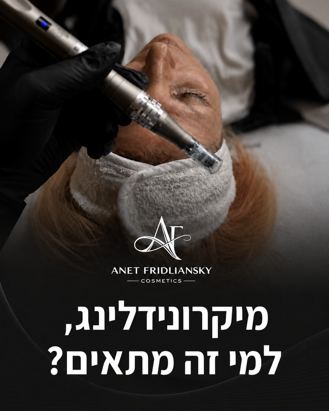 מיקרונידלינג הוא טיפול שמפעיל תהליך טבעי של התחדשות בעור בעזרת מחטים זעירות ומבוקרות. הוא יכול להתאים למראה של צלקות פוס
