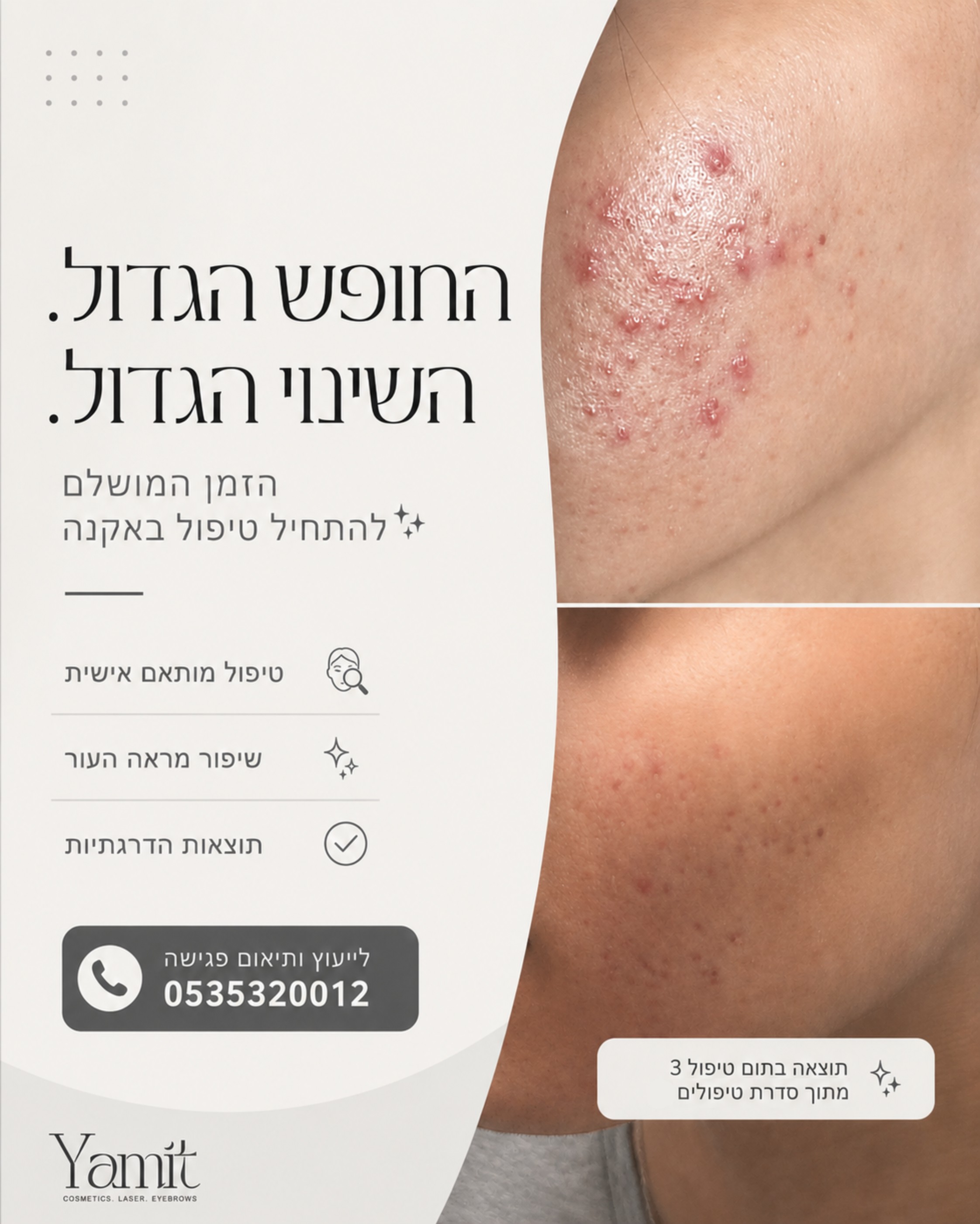 אקנה, צלקות, מרקם עור לא אחיד... אלו בעיות שיכולות להשפיע כל כך על הביטחון העצמי ועל איכות החיים. אני יודעת כמה מתסכל זה