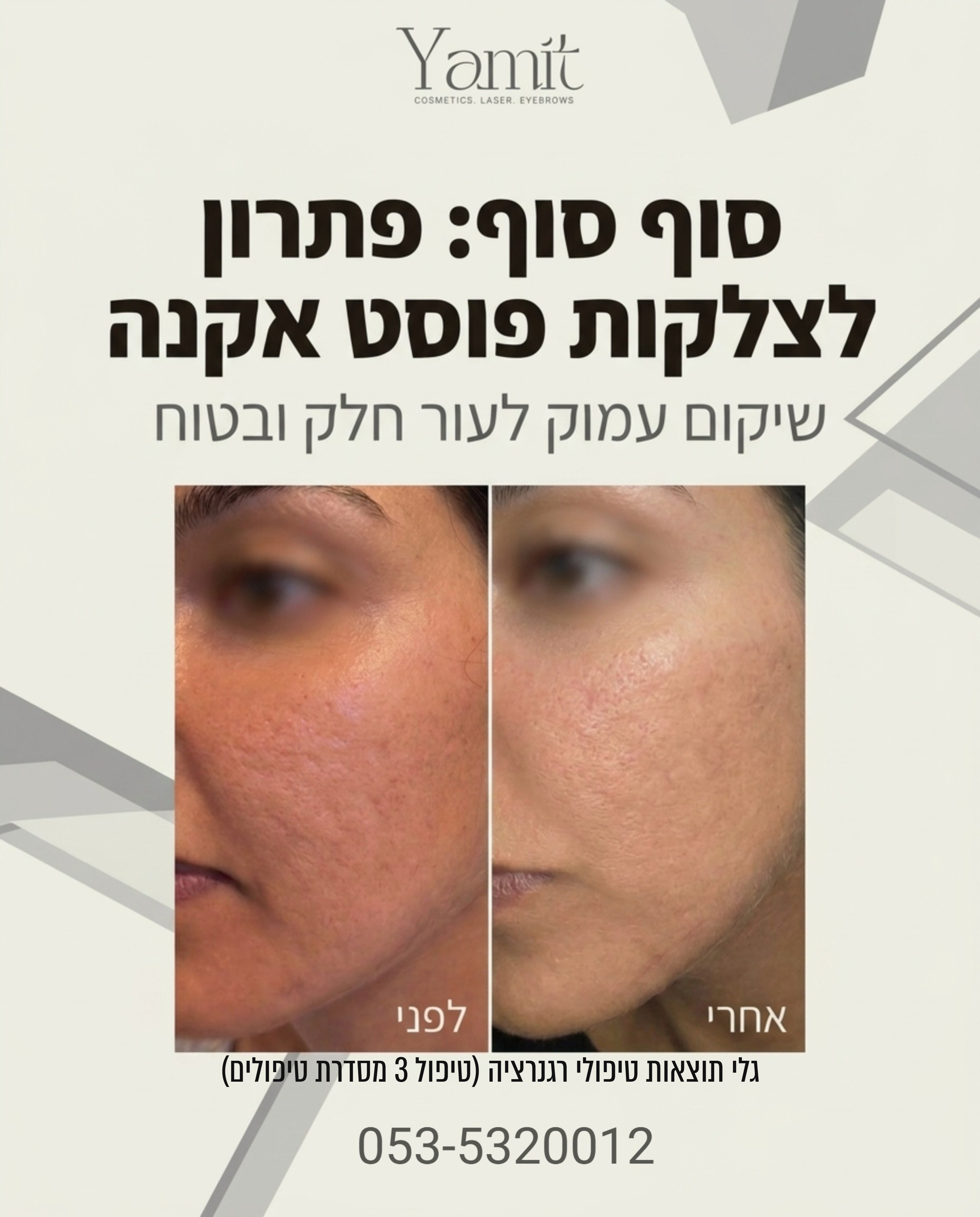 צלקות פוסט אקנה יכולות להשאיר סימן לא רק על העור, אלא גם על הביטחון העצמי. שנים של ניסיונות לטשטש אותן ללא הצלחה, יכולות